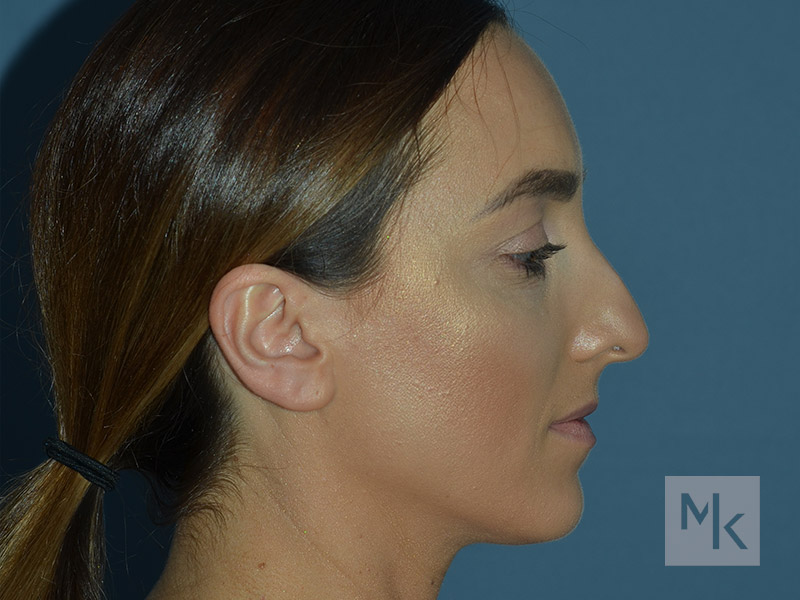 Rhinoplasty Before and After | Dr. Michael Kim