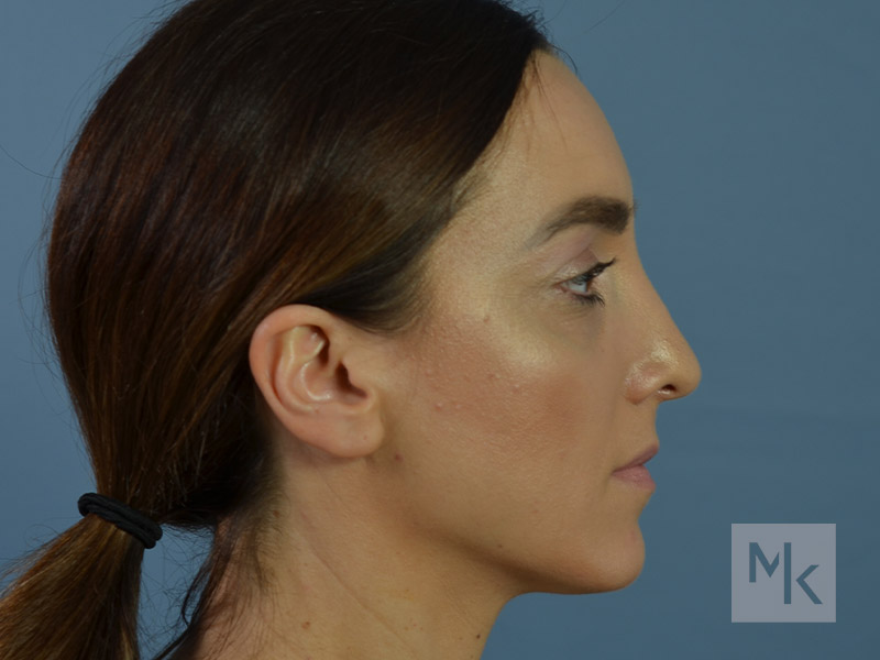 Rhinoplasty Before and After | Dr. Michael Kim