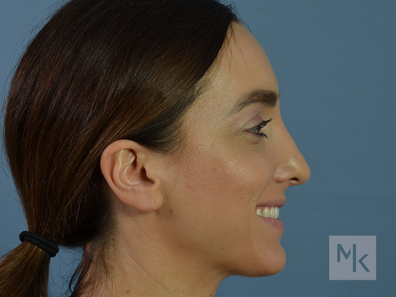 Rhinoplasty Before and After | Dr. Michael Kim