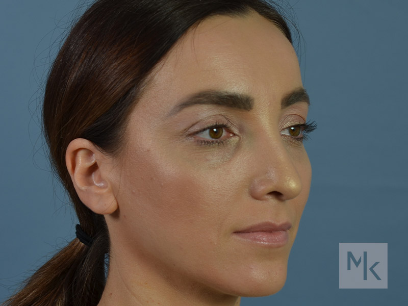 Rhinoplasty Before and After | Dr. Michael Kim