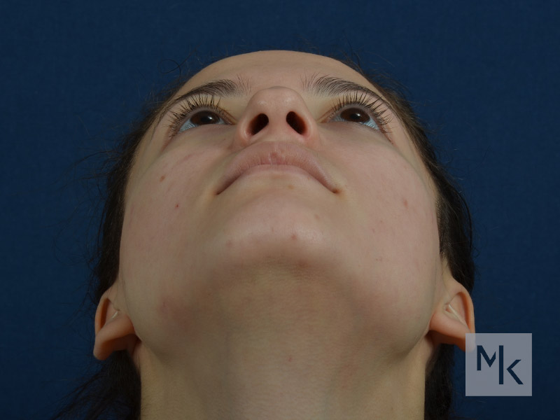 Rhinoplasty Before and After | Dr. Michael Kim