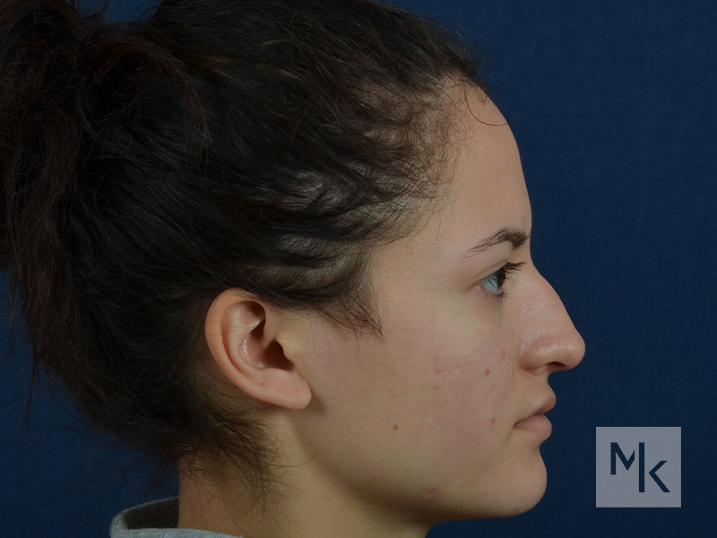 Rhinoplasty Before and After | Dr. Michael Kim