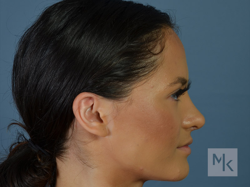 Rhinoplasty Before and After | Dr. Michael Kim