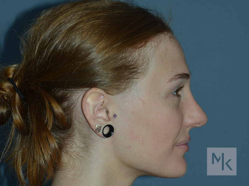 Rhinoplasty Before and After | Dr. Michael Kim