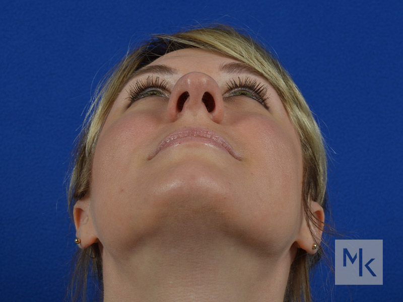 Rhinoplasty Before and After | Dr. Michael Kim