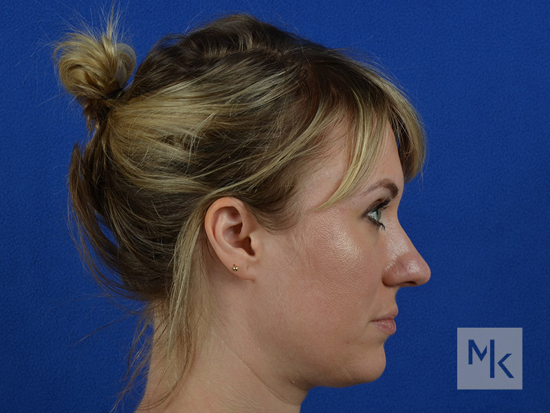 Rhinoplasty Before and After | Dr. Michael Kim