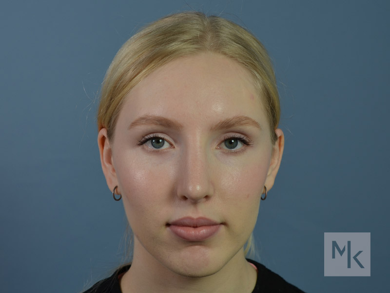 Rhinoplasty Before and After | Dr. Michael Kim