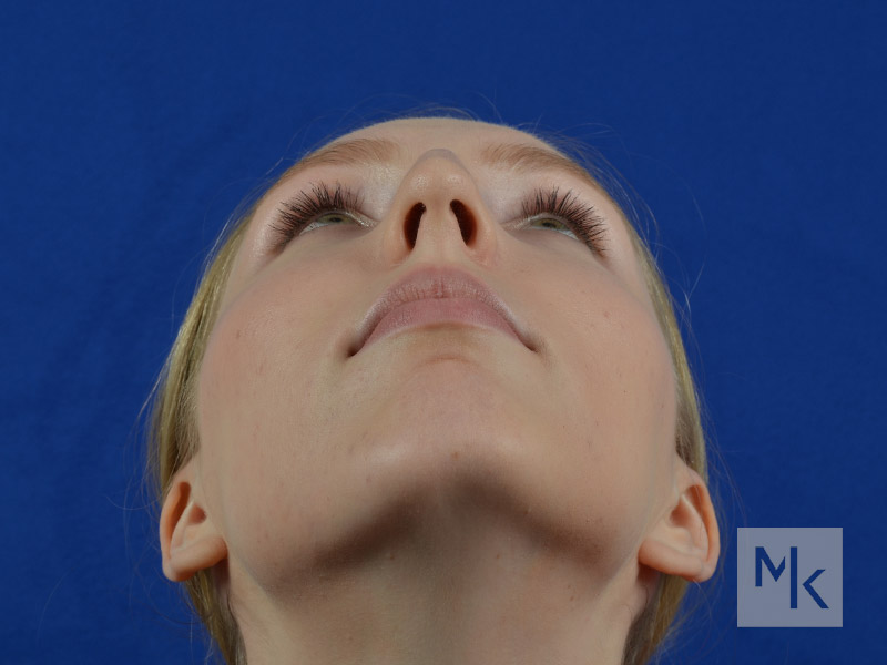 Rhinoplasty Before and After | Dr. Michael Kim