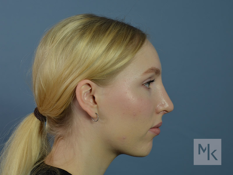 Rhinoplasty Before and After | Dr. Michael Kim