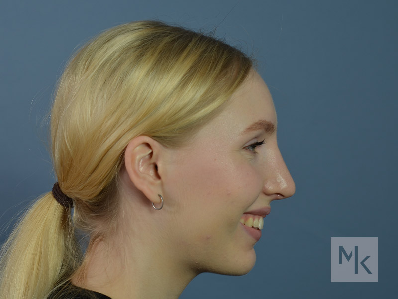 Rhinoplasty Before and After | Dr. Michael Kim