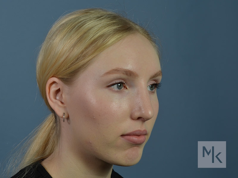 Rhinoplasty Before and After | Dr. Michael Kim