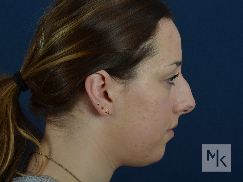 Rhinoplasty Before and After | Dr. Michael Kim