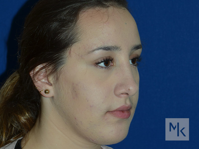 Rhinoplasty Before and After | Dr. Michael Kim