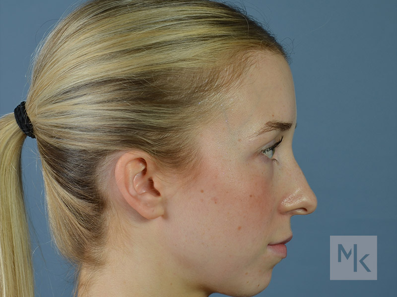 Rhinoplasty Before and After | Dr. Michael Kim