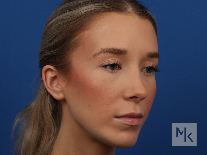 Rhinoplasty Before and After | Dr. Michael Kim