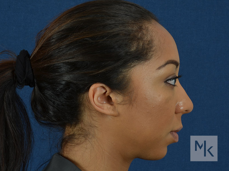 Rhinoplasty Before and After | Dr. Michael Kim