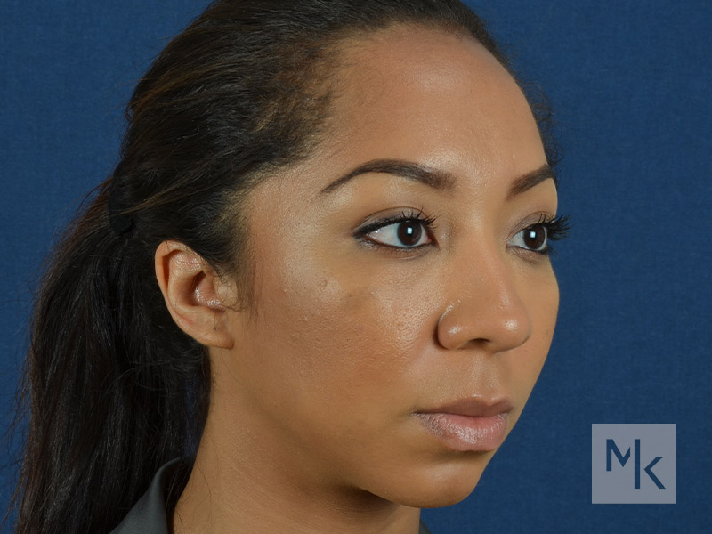 Rhinoplasty Before and After | Dr. Michael Kim