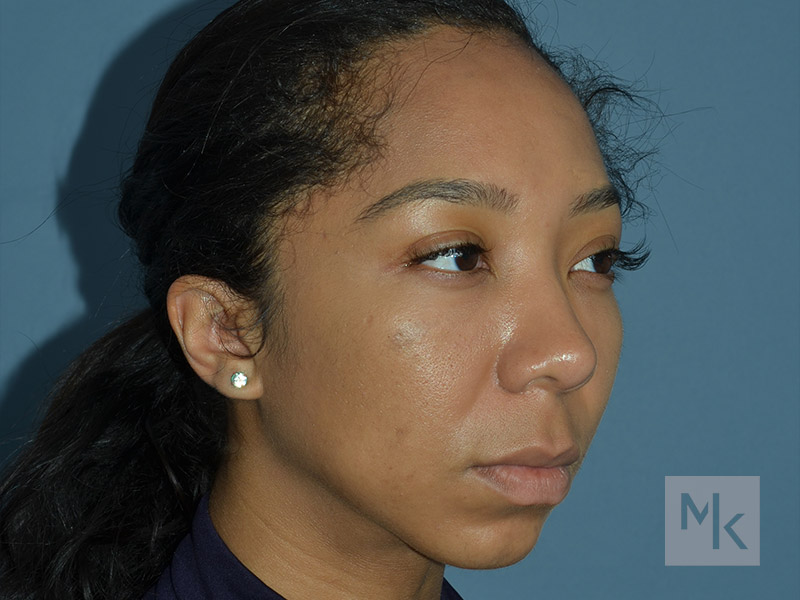 Rhinoplasty Before and After | Dr. Michael Kim