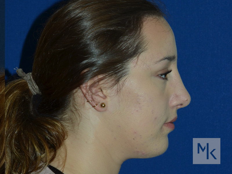 Rhinoplasty Before and After | Dr. Michael Kim