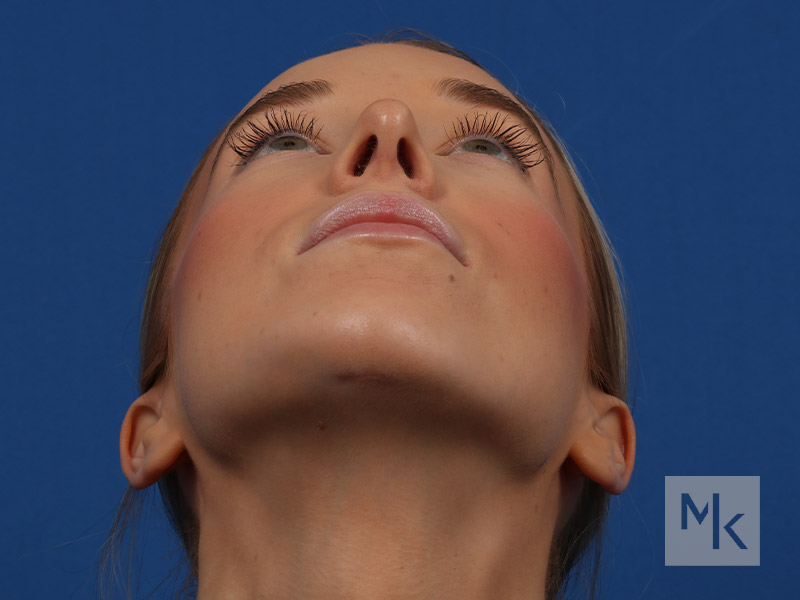 Rhinoplasty Before and After | Dr. Michael Kim