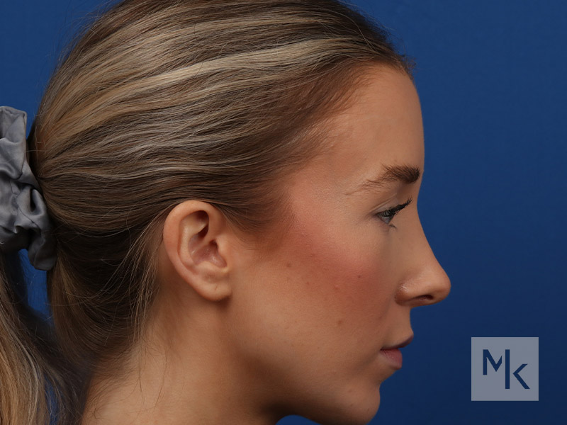 Rhinoplasty Before and After | Dr. Michael Kim