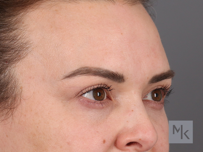 Upper Blepharoplasty Before and After | Dr. Michael Kim