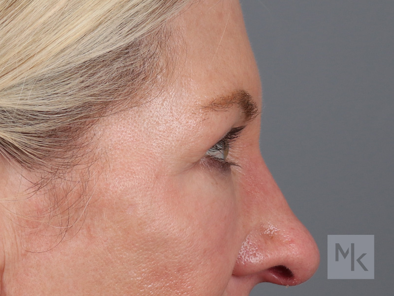 Upper Blepharoplasty Before and After | Dr. Michael Kim