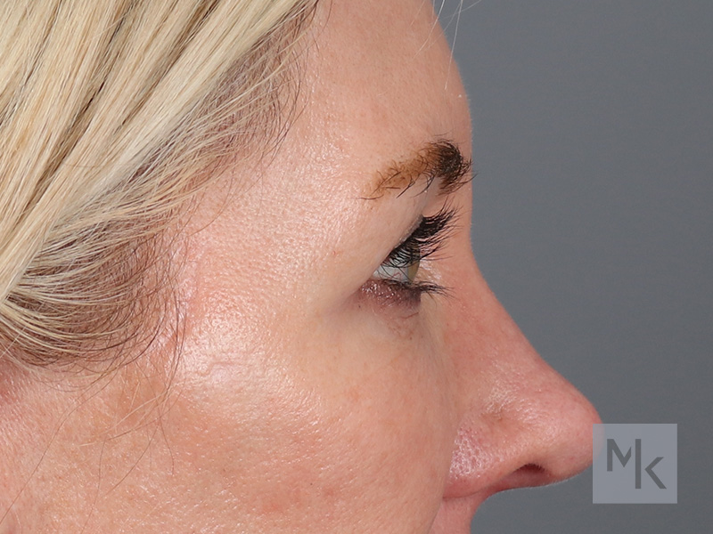 Upper Blepharoplasty Before and After | Dr. Michael Kim