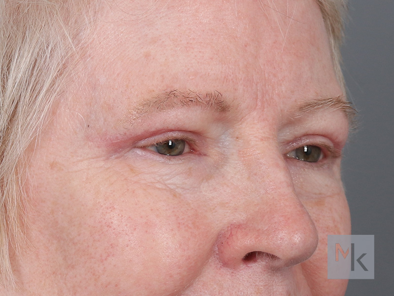 Upper Blepharoplasty Before and After | Dr. Michael Kim