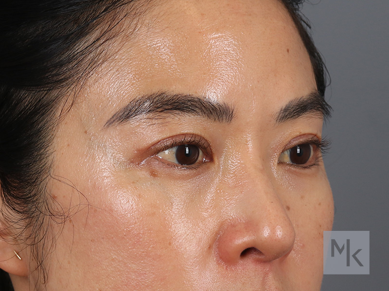 Upper Blepharoplasty Before and After | Dr. Michael Kim