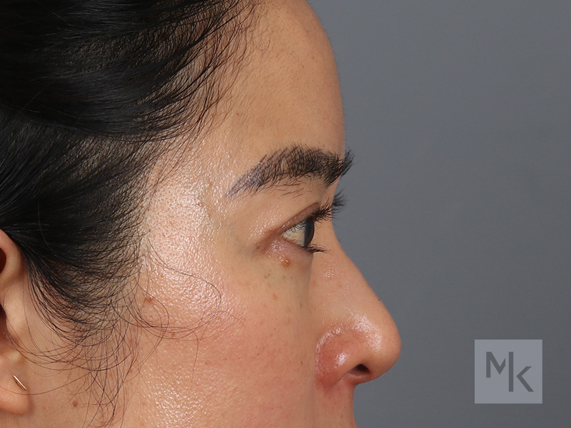 Upper Blepharoplasty Before and After | Dr. Michael Kim