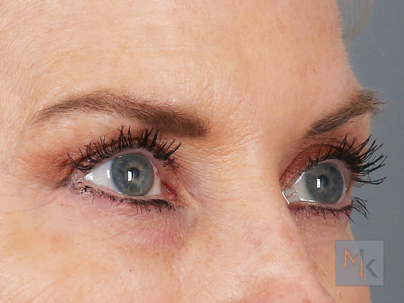 Upper Blepharoplasty Before and After | Dr. Michael Kim