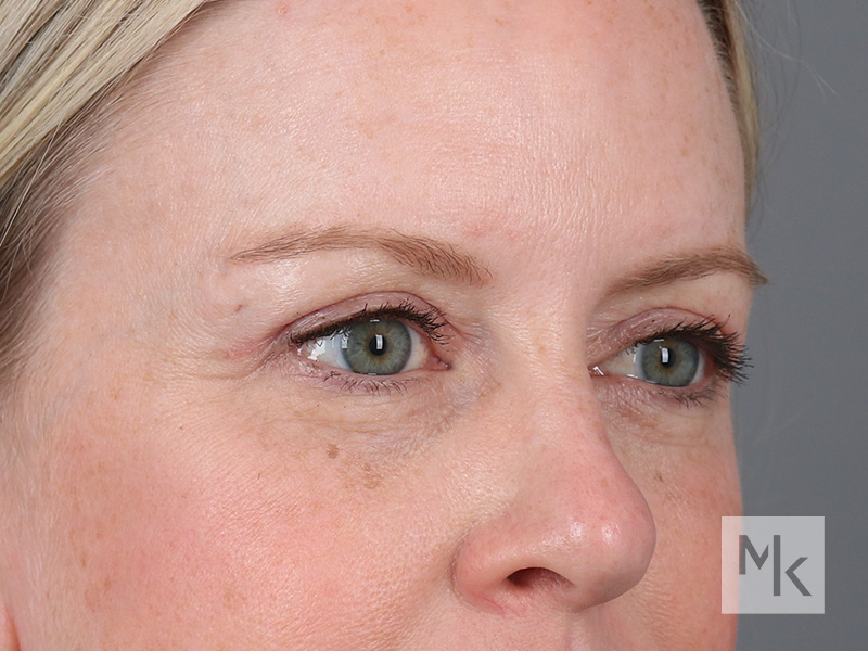 Upper Blepharoplasty Before and After | Dr. Michael Kim