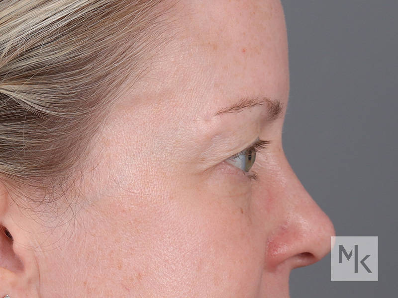 Upper Blepharoplasty Before and After | Dr. Michael Kim