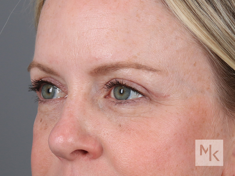 Upper Blepharoplasty Before and After | Dr. Michael Kim