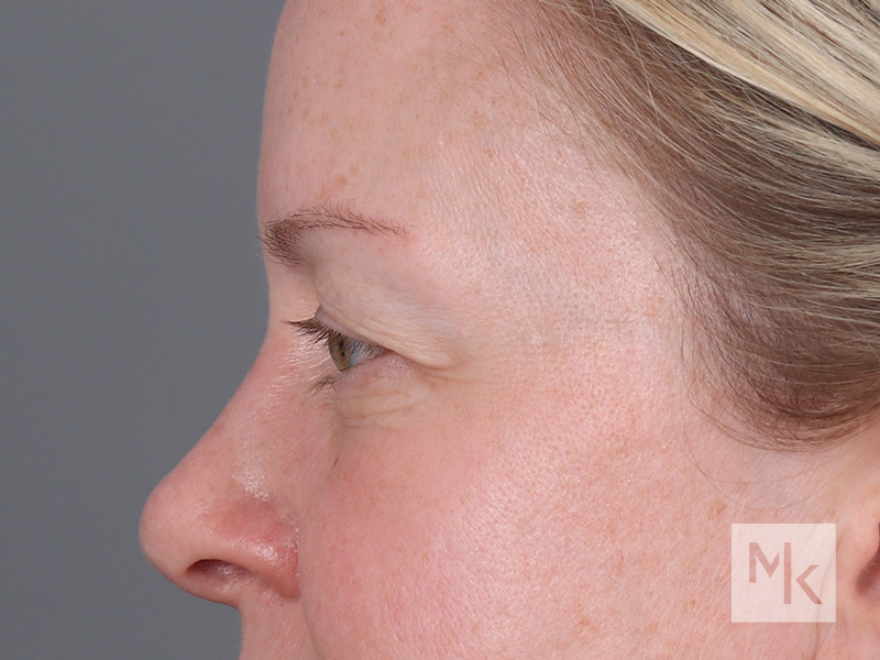 Upper Blepharoplasty Before and After | Dr. Michael Kim