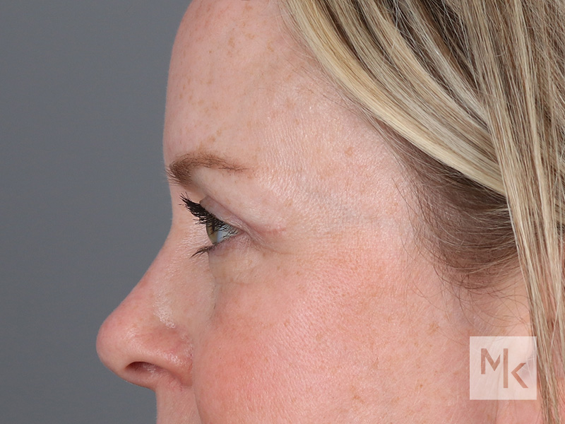 Upper Blepharoplasty Before and After | Dr. Michael Kim