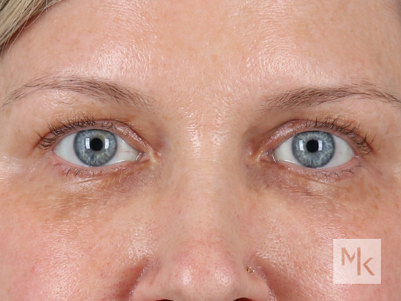 Upper Blepharoplasty Before and After | Dr. Michael Kim