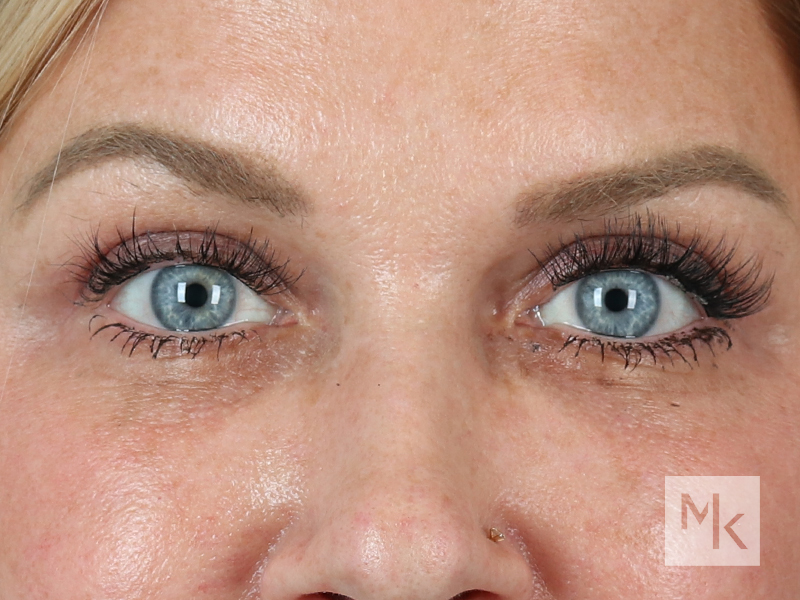 Upper Blepharoplasty Before and After | Dr. Michael Kim