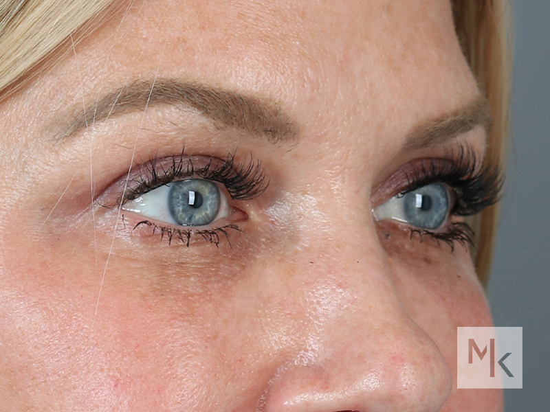 Upper Blepharoplasty Before and After | Dr. Michael Kim