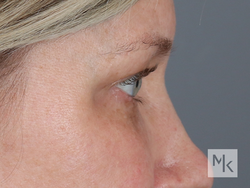 Upper Blepharoplasty Before and After | Dr. Michael Kim