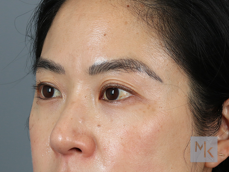 Upper Blepharoplasty Before and After | Dr. Michael Kim