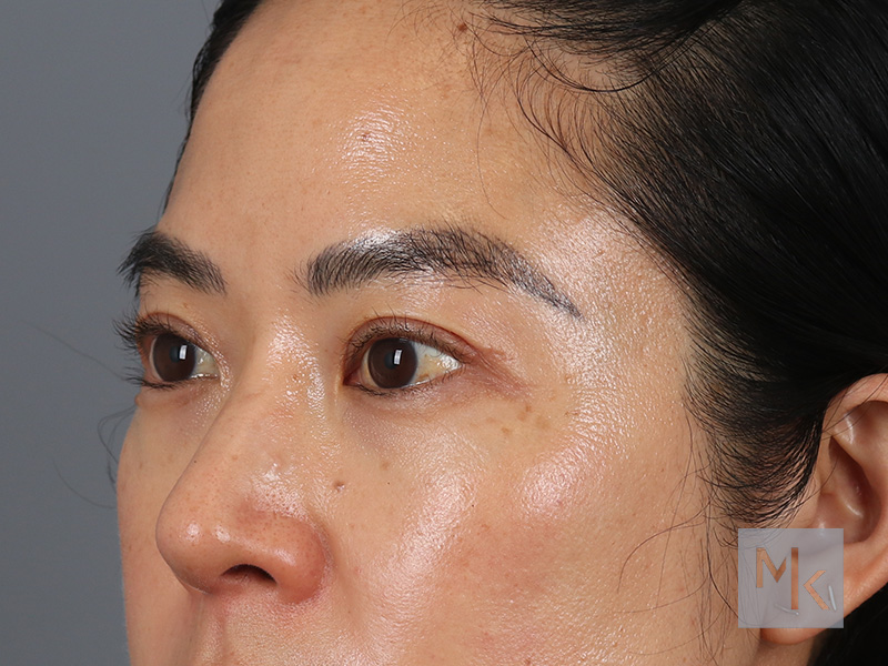 Upper Blepharoplasty Before and After | Dr. Michael Kim