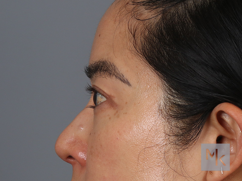 Upper Blepharoplasty Before and After | Dr. Michael Kim