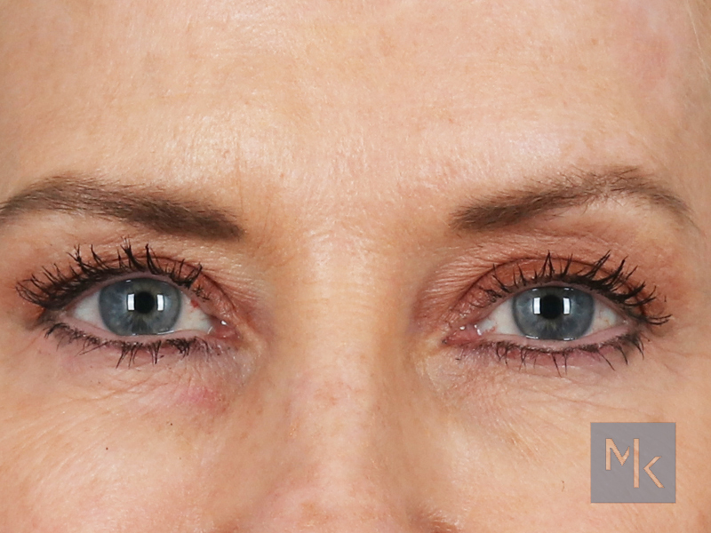 Upper Blepharoplasty Before and After | Dr. Michael Kim