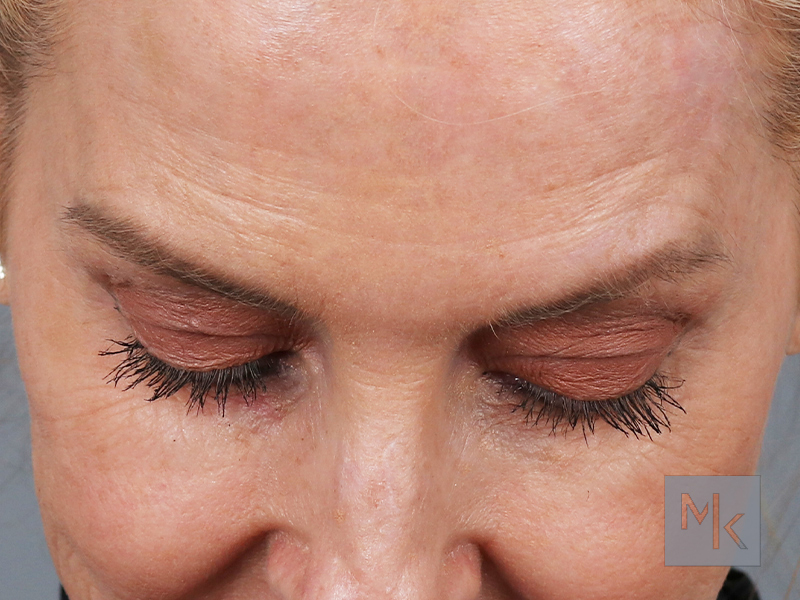 Upper Blepharoplasty Before and After | Dr. Michael Kim