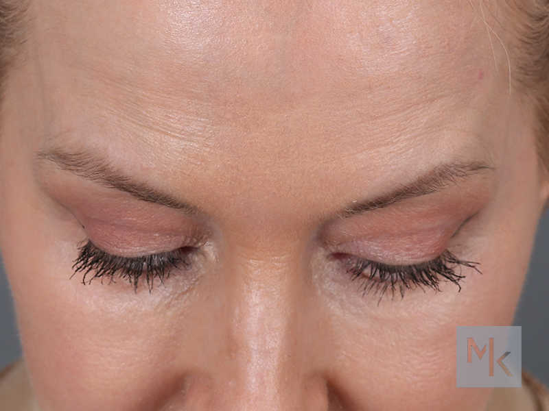 Upper Blepharoplasty Before and After | Dr. Michael Kim