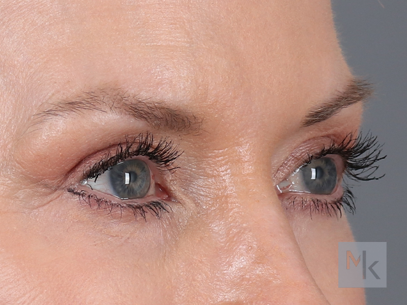 Upper Blepharoplasty Before and After | Dr. Michael Kim