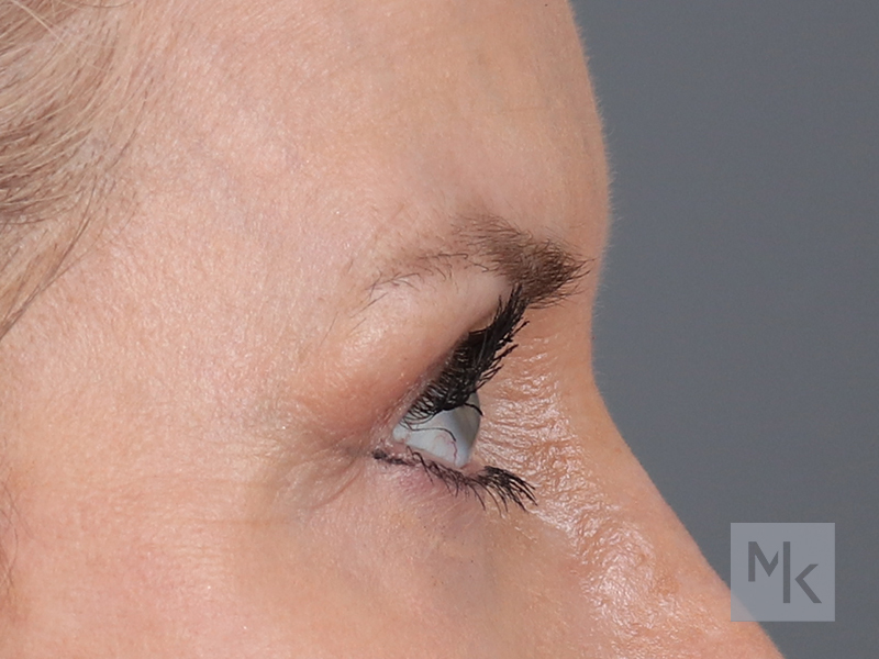 Upper Blepharoplasty Before and After | Dr. Michael Kim