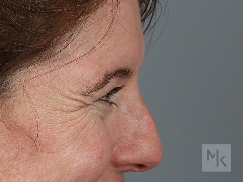 Upper Blepharoplasty Before and After | Dr. Michael Kim